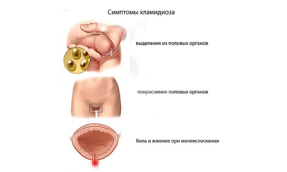 Симптомы эндометриоза