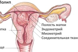 Схема полипа шейки матки