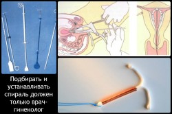 Установка внутриматочной спирали как способ контрацепции Установка внутриматочной спирали как способ контрацепции