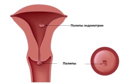 Схема полипов матки Схема полипов матки