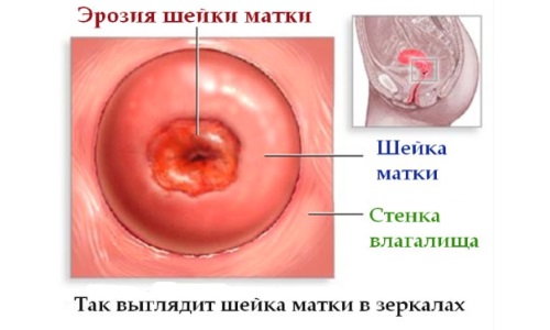 Как вылечиться от эрозии шейки матки таблетками?