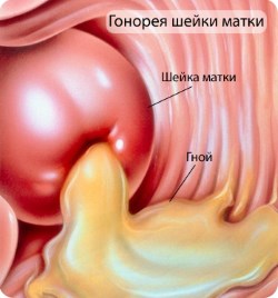 Гонорея - симптом бежевых выделений