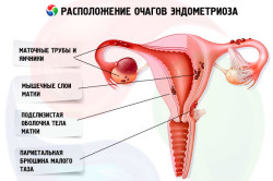 Расположение очагов эндометриоза