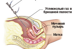 Как лечить эндометриоз без применения гормонов: немедикаментозные методы