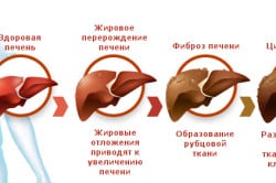 Стадии развития плоскоклеточного рака