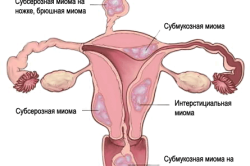 Миома матки - противопоказание к медикаментозному аборту