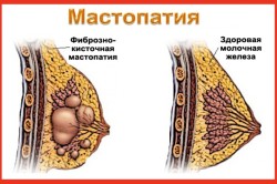 Мастопатия Мастопатия