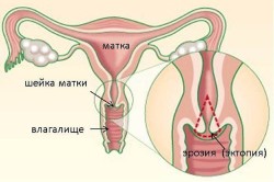 Схема эктопии шейки матки Схема эктопии шейки матки