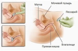 Схема наложения пессария