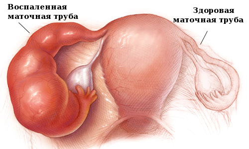 Проблема оофорита