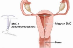 Схема установки внутриматочной спирали