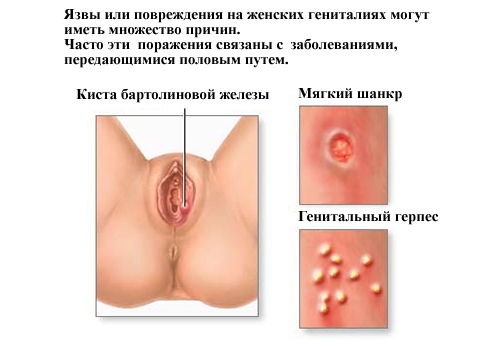 Лечение герпеса спринцеванием марганцовкой