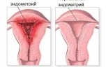 Послеродовой эндометрит