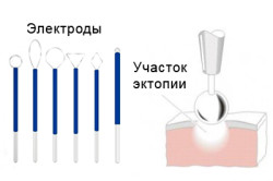 Схема диатермокоагуляции