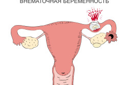 Разрыв трубы при внематочной беременности Разрыв трубы при внематочной беременности