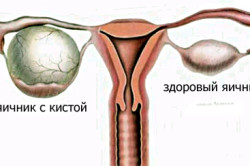 Кисты яичников