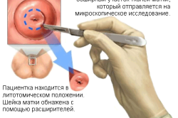 Проведение клиновидной биопсии шейки матки
