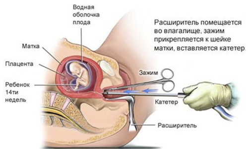 Процедура выскабливания