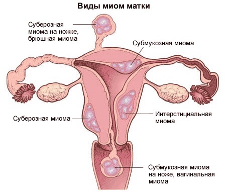 Схема миомы при беременности