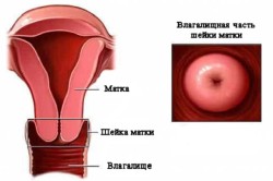Нужно ли проводить лечение метаплазии шейки матки?