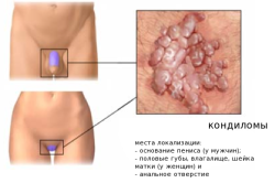 Схема кондилом в интимных местах
