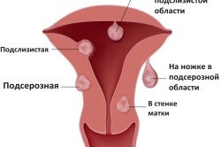 Миома матка причина задержки менструации 