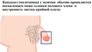 Молочница у мужчин