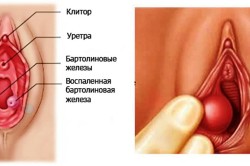 Схема воспаления бартолиновой железы