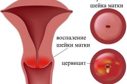 Каковы симптомы хронического цервицита