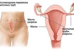 Какие могут быть последствия, если перевязать маточные трубы?