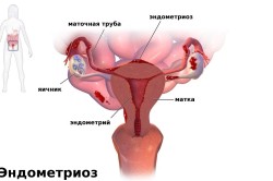 Эндометриоз как причина развития непроходимости маточных труб