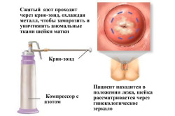 Криодеструкция шейки матки