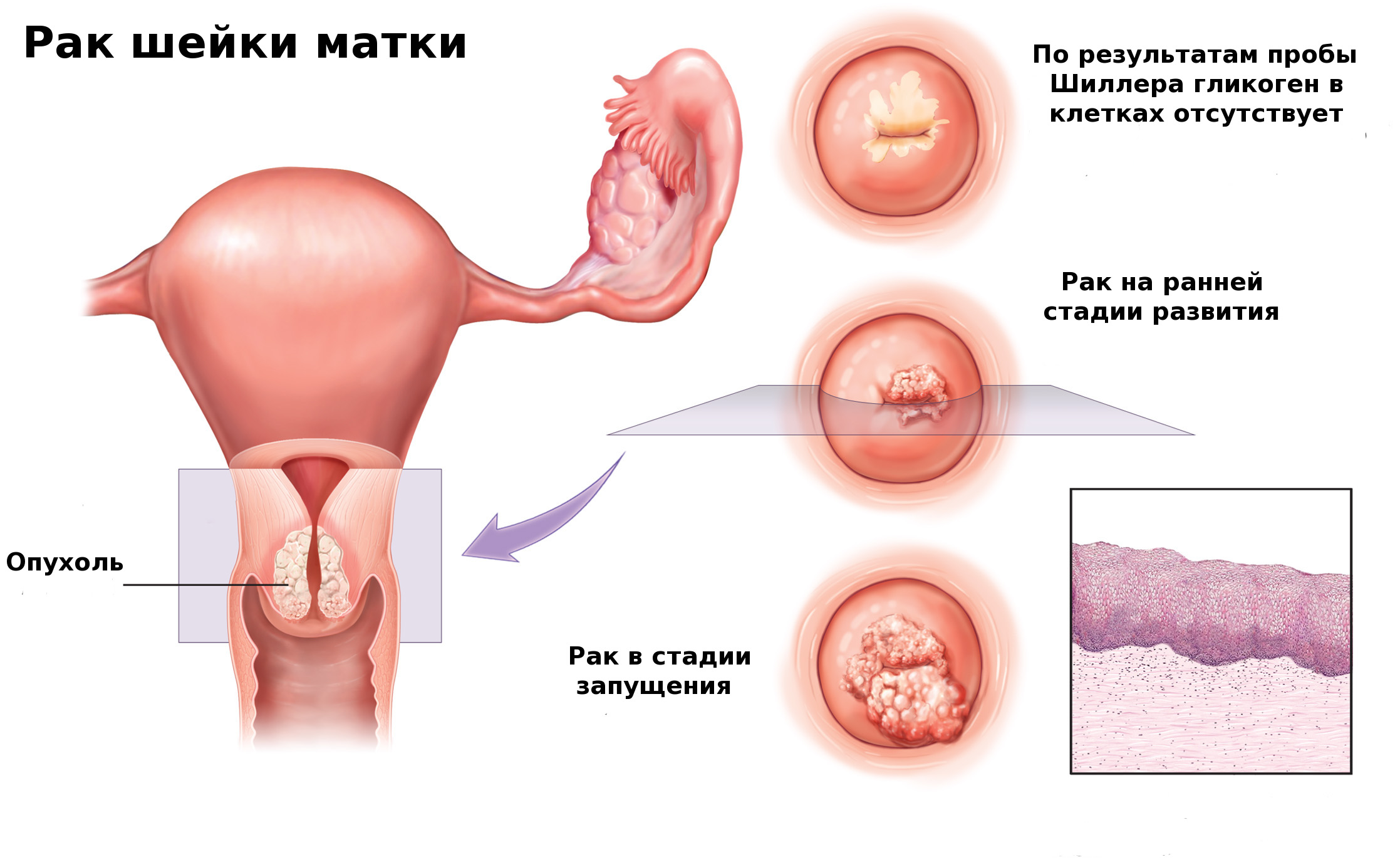 Лейкоплакия шейки матки