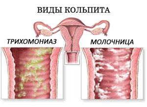 Виды кольпита