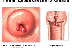 Полип цервикального канала: возможные причины возникновения и лечение