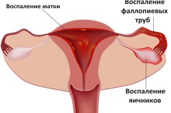 Причины и симптомы эндометрита у женщин