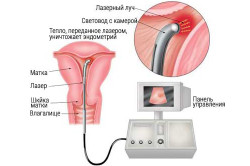 Гиперплазия эндометрия