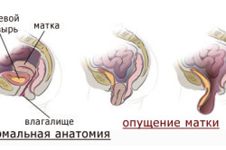 Схема опущения шейки матки