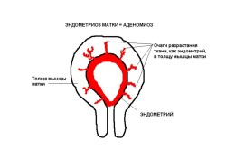 Симптомы и лечение аденомиоза матки