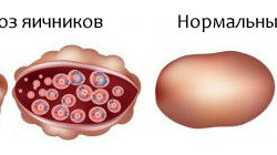 Поликистоз яичников
