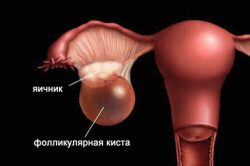 Схема фолликулярной кисты