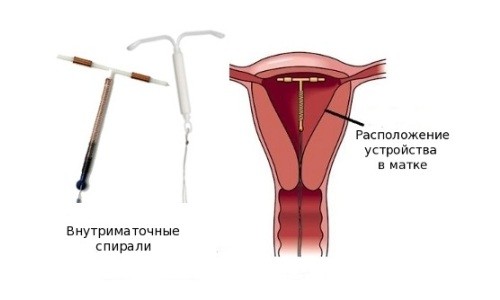 Внутриматочная спираль для контрацепции: какая лучше?