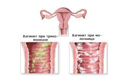 Разновидности вагинита