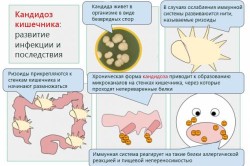 Кандидоз кишечника