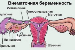 Проведение лапароскопии при внематочной беременности