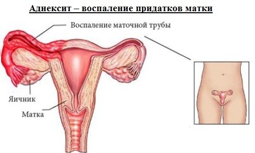 Проблема аднексита