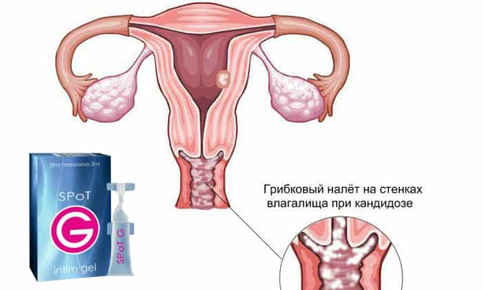 Проблема молочницы у женщин