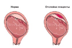 Отслойка плодного яйца