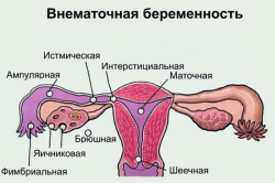 Виды внематочной беременности