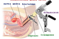 Кальпоскопия шейки матки при ВПЧ